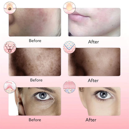 Blosshera™Photon Therapy Beauty Mask